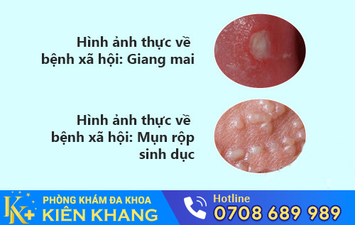 Hình ảnh bệnh giang mai, mụn rộp sinh dục