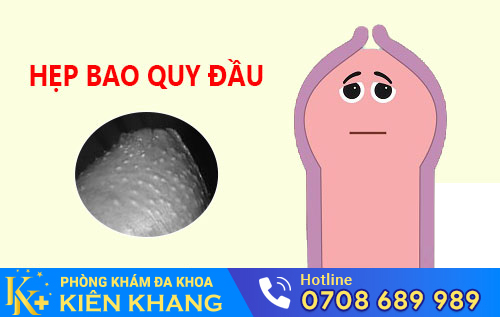 Hình ảnh hẹp bao quy đầu ở nam