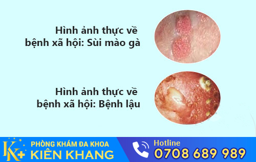 Hình ảnh bệnh sùi mào gà, bệnh lậu
