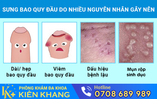 Sưng bao quy đầu do nhiều nguyên nhân gây nên