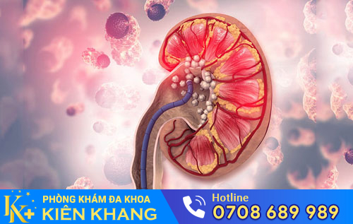 Bệnh sỏi thận