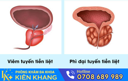 Bệnh về tuyến tiền liệt