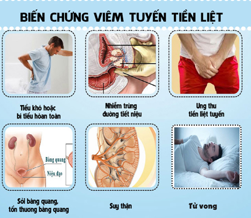 Biến chứng của viêm tuyến tiền liệt
