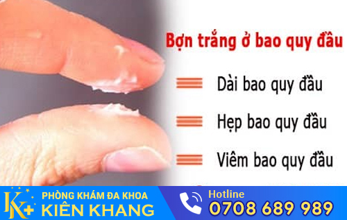 Viêm bao quy đầu làm xuất hiện các bợn trắng