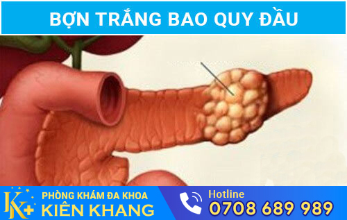 Hình ảnh bợn trắng bao quy đầu