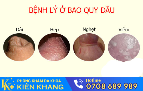 Tình trạng bất thường cảnh báo bệnh lý ở bao quy đầu