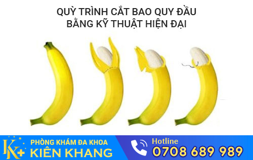 Quy trình cắt bao quy đầu