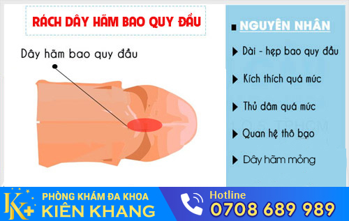 Có nên cắt dây hãm bao quy đầu?