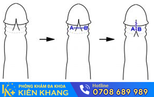 Dây hãm bao quy đầu hay còn gọi là dây thắng bao quy đầu