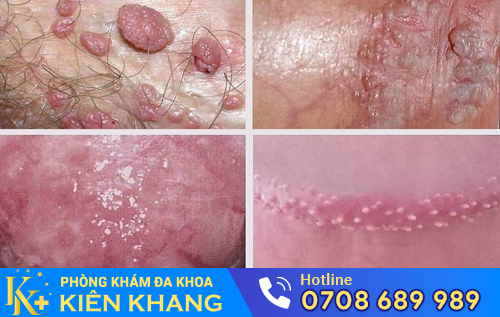 Dương vật nổi hạch do sùi mào gà