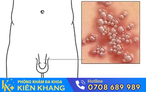 Dương vật nổi mẩn đỏ là dấu hiệu nhiều bệnh nguy hiểm