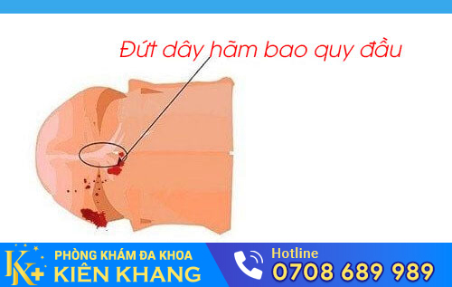 Đứt dây hãm bao quy đầu