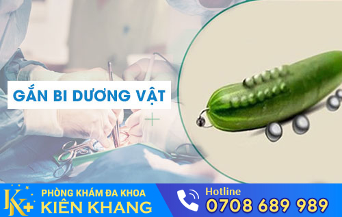 Gắn bi dương vật