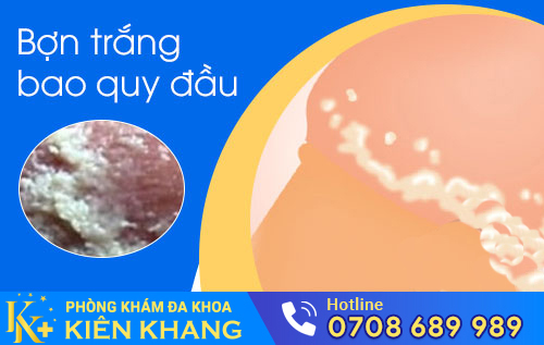 Hình ảnh bợn trắng bao quy đầu