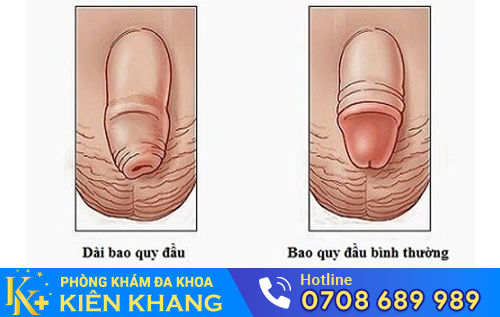 Hình ảnh dài bao quy đầu