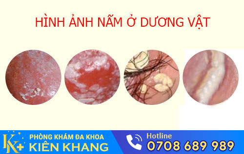 Hình ảnh nấm dương vật