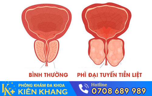 Hình ảnh phì đại tuyến tiền liệt