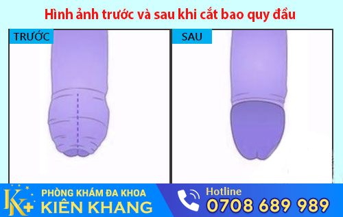 Hình ảnh trước và sau khi cắt bao quy đầu