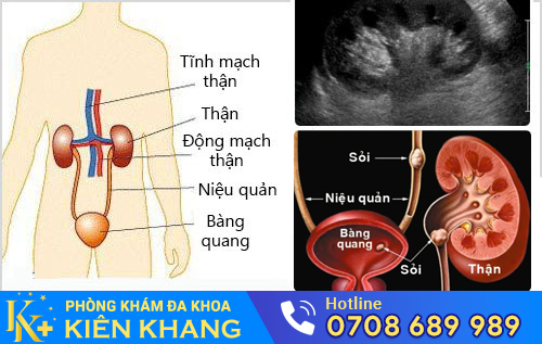 Siêu âm hệ tiết niệu trong gói khám sàng lọc bệnh tiết niệu