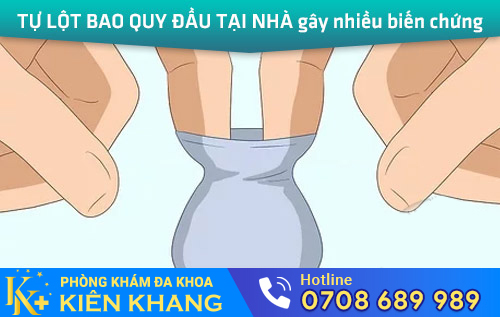 Tự lột bao quy đầu tại nhà gây nhiều biến chứng nguy hiểm