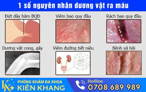 Dương vật ra máu do nhiều bệnh lý nguy hiểm