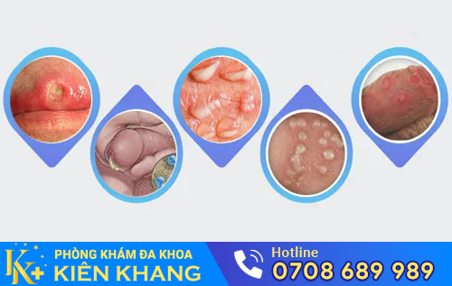 Nguyên nhân dương vật bị hôi