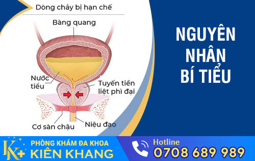 Nguyên nhân gây bí tiểu
