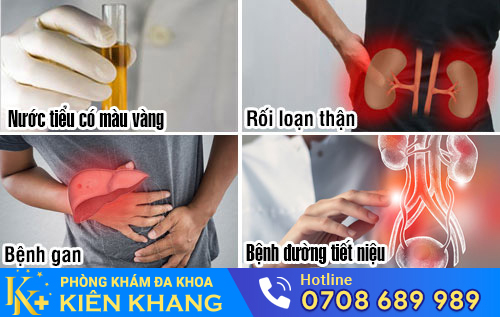 Nguyên nhân nước tiểu có màu vàng