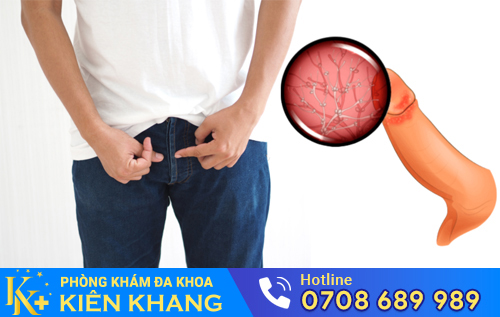 Nấm bao quy đầu ở nam giới
