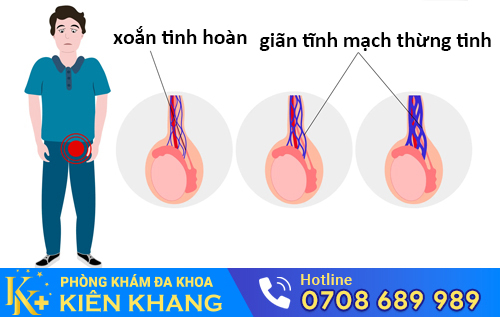 Nhóm bệnh tinh hoàn gồm có: xoắn tinh hoàn, giãn tĩnh mạch thừng tinh,...