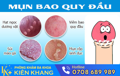 Hình ảnh nổi mụn bao quy đầu