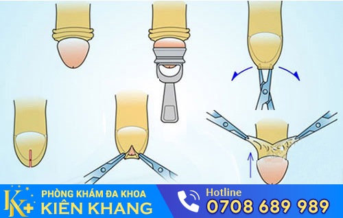 Phương pháp cắt bao quy đầu hiện đại