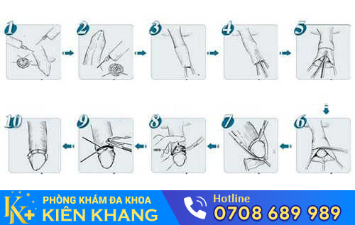 Quy trình cắt bao quy đầu theo công nghệ hiện đại