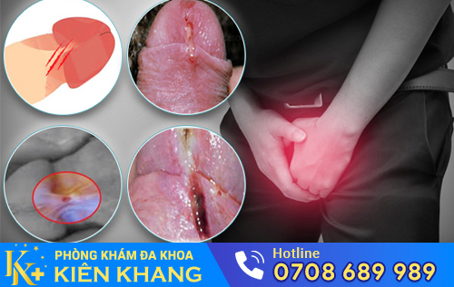 Hình ảnh rách bao quy đầu