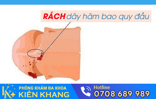 Rách dây hãm bao quy đầu