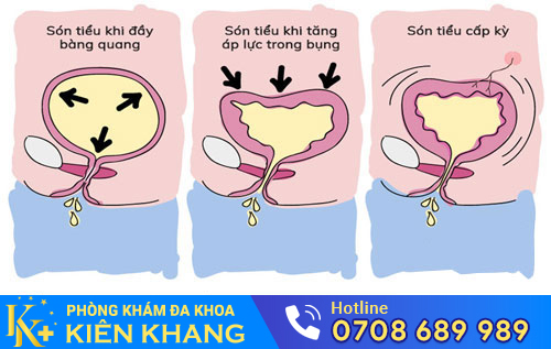 Són tiểu ở nam giới