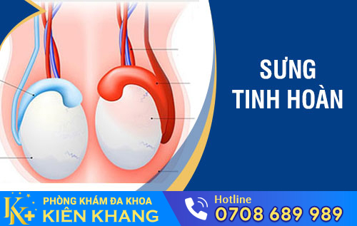 Sưng tinh hoàn là dấu hiệu bệnh gì?