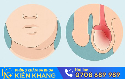 Sưng tinh hoàn bên trái là dấu hiệu nhiều bệnh nguy hiểm