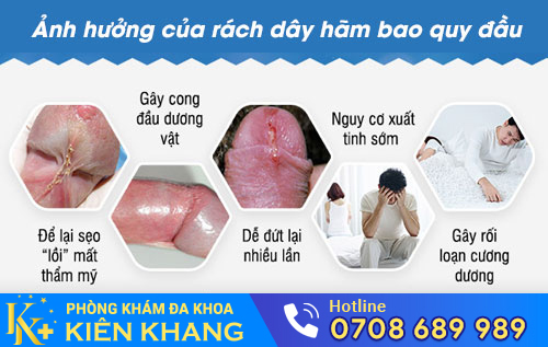 Ảnh hưởng của rách dây hãm bao quy đầu