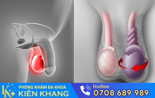 Nhiều tác hại nguy hiểm khi bị sưng tinh hoàn trái