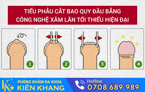 Cắt bao quy đầu giúp kéo dài thời gian quan hệ