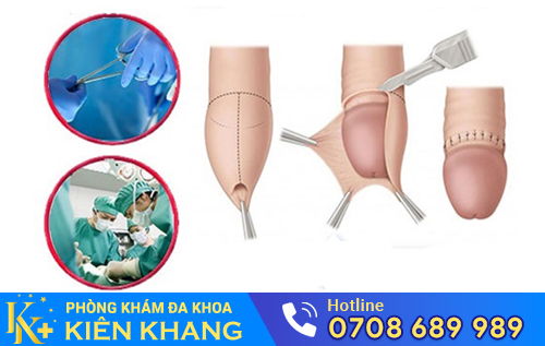 Tiểu phẫu thông nối cắt bao quy đầu tự hào là kỹ thuật tốt và hiện đại