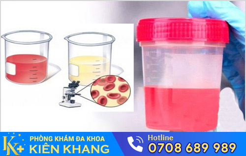 Tiểu ra máu đại thể và vi thể ở nam giới