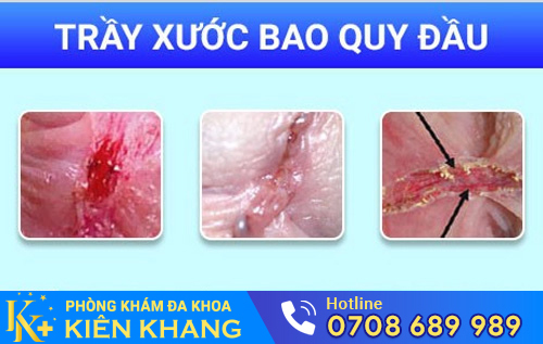 tray-xuoc-bao-quy-dau-250722