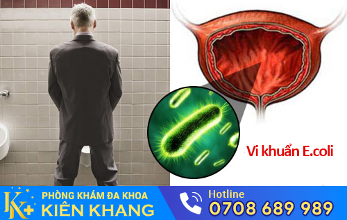 Viêm đường tiết niệu do vi khuẩn E.coli gây ra