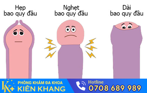 Nam giới có bao quy đầu dài, hẹp nên thực hiện cắt bao quy đầu