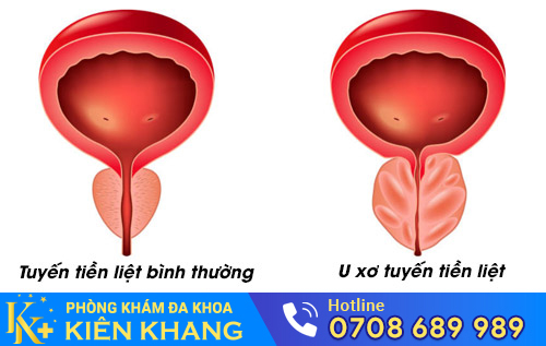 U xơ tuyến tiền liệt