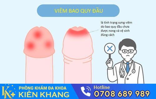Viêm bao quy đầu gây lở loét bao quy đầu