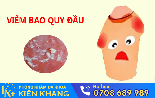 Viêm bao quy đầu làm xuất hiện các bợn trắng