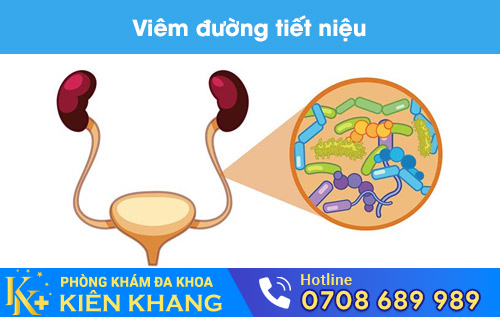 Viêm đường tiết niệu